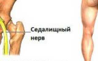 Защемление, воспаление седалищного нерва – симптомы и лечение