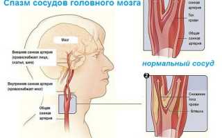 Сосудистый генез головного мозга: что это такое и как его лечить