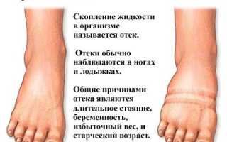 Почему опухают ноги в районе стопы у женщин, лечение отеков