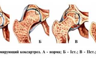 Лечение диспластического коксартроза тазобедренного сустава