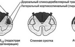 Что такое сухотка спинного мозга, основные симптомы