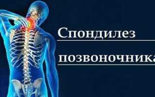 Лечебная физкультура в лечении спондилеза позвоночника