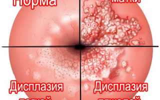 Дисплазия шейки матки, CIN, SIL. Информация от врача.