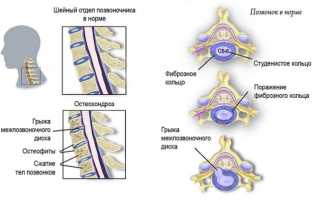 Использование никотиновой кислоты для лечения остеохондроза