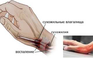 Тендовагинит кисти — описание, лечение и профилактика
