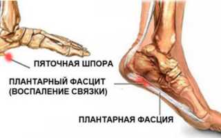 Проведение рентгенотерапии при пяточных шпорах с целью лечения