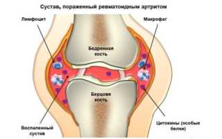 Детский артрит коленного сустава: симптомы и лечение