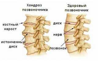 Что такое хондроз позвоночника и как его вылечить?