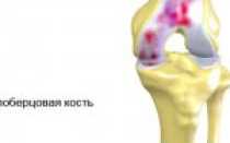 Артроз коленного сустава 2 степени: причины возникновения, симптомы и лечение заболевания