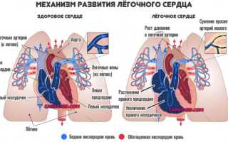 Что такое легочная гипертензия: симптомы, лечение и прогноз жизни