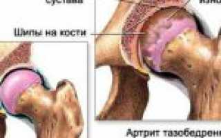 КТ тазобедренного сустава: особенности компьютерной диагностики