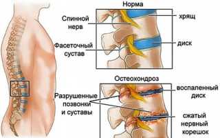 Свойства и применение Дексаметазона при остеохондрозе, есть ли противопоказания?