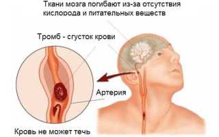 Ишемический инсульт левой стороны: причины, симптомы, последствия